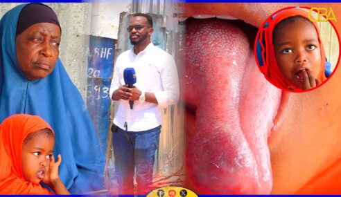 Gabar sadex sano jir ah oo meel halis ah kaga dhacay cudur noociisa ay garan waayeen dhakhaatiirta dalka.